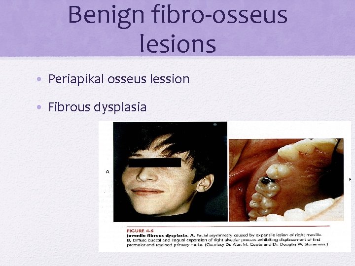 Benign fibro-osseus lesions • Periapikal osseus lession • Fibrous dysplasia 