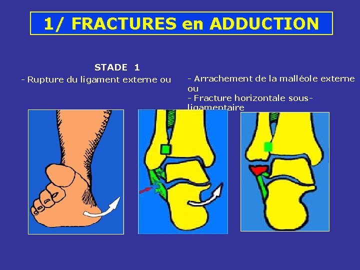 1/ FRACTURES en ADDUCTION STADE 1 - Rupture du ligament externe ou - Arrachement 1/ FRACTURES en ADDUCTION STADE 1 - Rupture du ligament externe ou - Arrachement