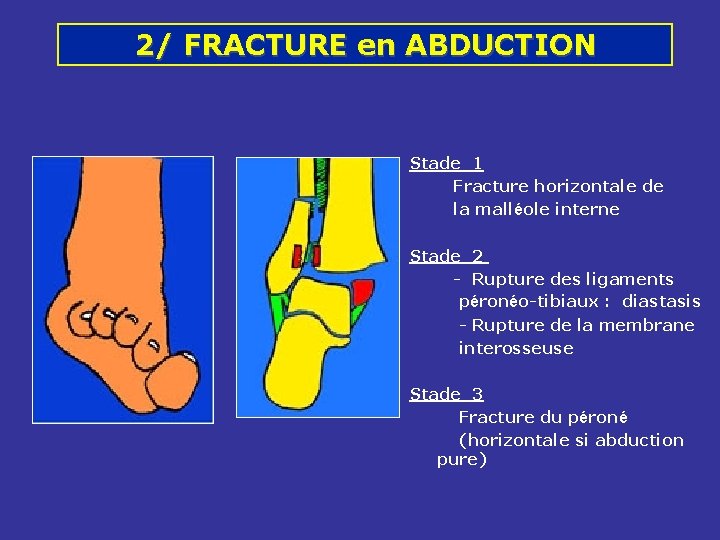 2/ FRACTURE en ABDUCTION Stade 1 Fracture horizontale de la malléole interne Stade 2 2/ FRACTURE en ABDUCTION Stade 1 Fracture horizontale de la malléole interne Stade 2