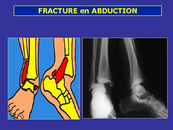 FRACTURE en ABDUCTION FRACTURE en ABDUCTION