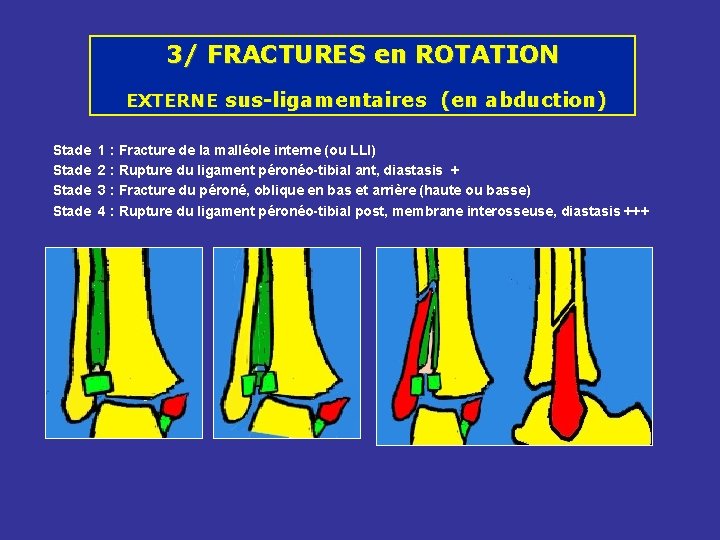 3/ FRACTURES en ROTATION EXTERNE sus-ligamentaires (en abduction) Stade 1 : Fracture de la 3/ FRACTURES en ROTATION EXTERNE sus-ligamentaires (en abduction) Stade 1 : Fracture de la