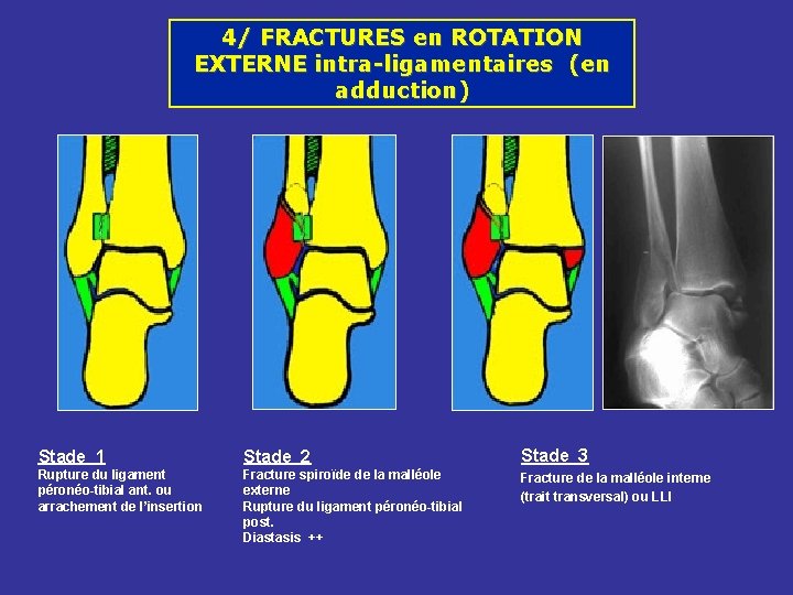 4/ FRACTURES en ROTATION EXTERNE intra-ligamentaires (en adduction) Stade 1 Stade 2 Stade 3 4/ FRACTURES en ROTATION EXTERNE intra-ligamentaires (en adduction) Stade 1 Stade 2 Stade 3