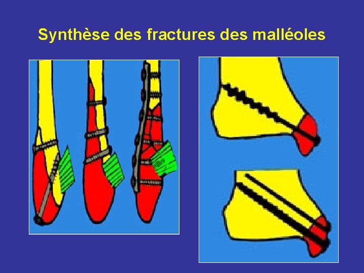 Synthèse des fractures des malléoles Synthèse des fractures des malléoles