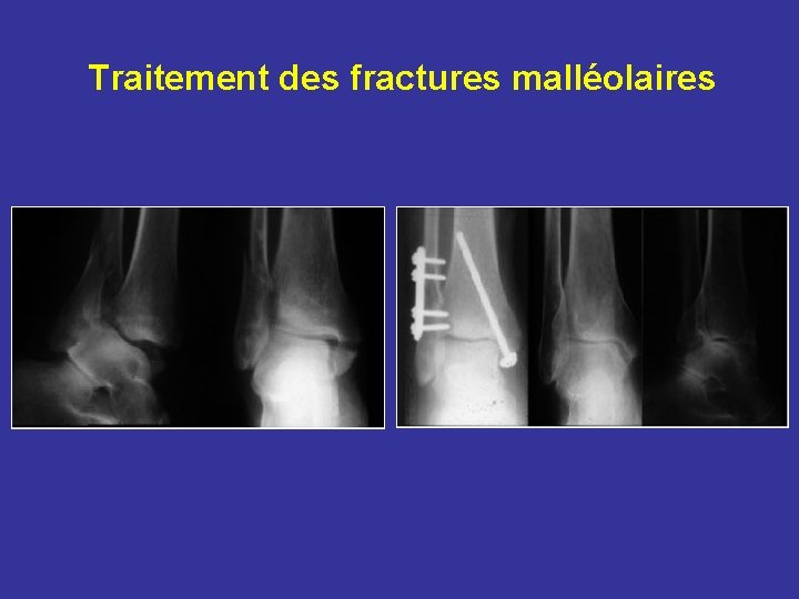 Traitement des fractures malléolaires Traitement des fractures malléolaires