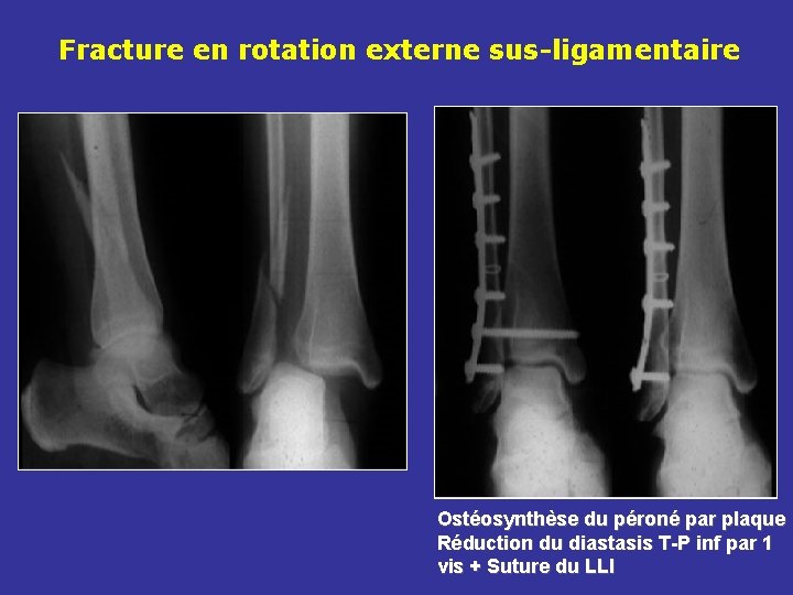 Fracture en rotation externe sus-ligamentaire Ostéosynthèse du péroné par plaque Réduction du diastasis T-P Fracture en rotation externe sus-ligamentaire Ostéosynthèse du péroné par plaque Réduction du diastasis T-P