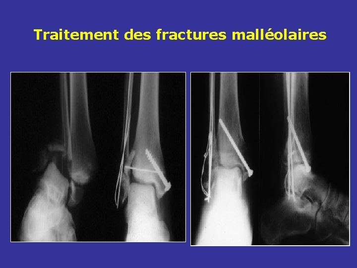 Traitement des fractures malléolaires Traitement des fractures malléolaires