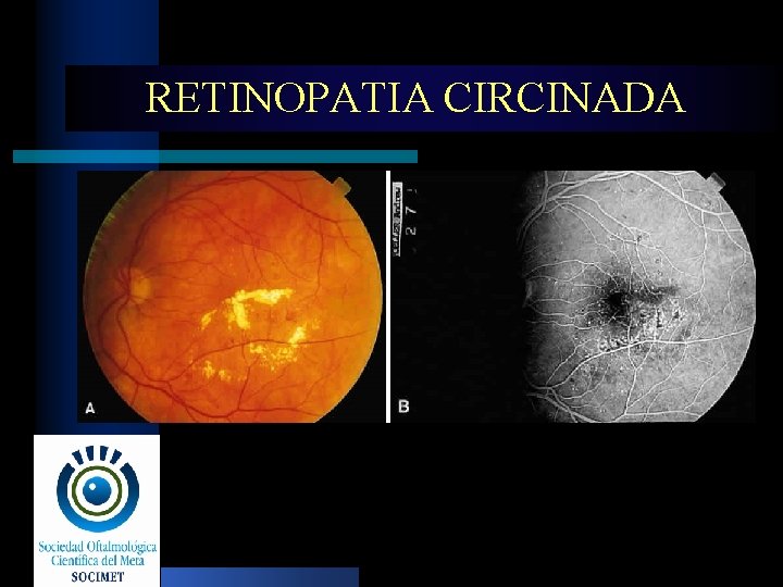 RETINOPATIA CIRCINADA 