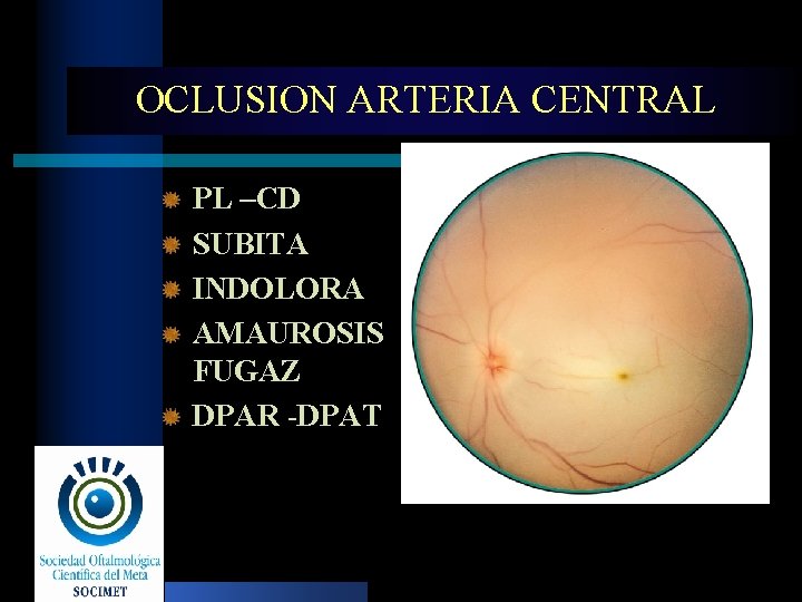 OCLUSION ARTERIA CENTRAL PL –CD SUBITA INDOLORA AMAUROSIS FUGAZ DPAR -DPAT 