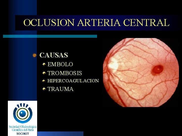 OCLUSION ARTERIA CENTRAL CAUSAS EMBOLO TROMBOSIS HIPERCOAGULACION TRAUMA 