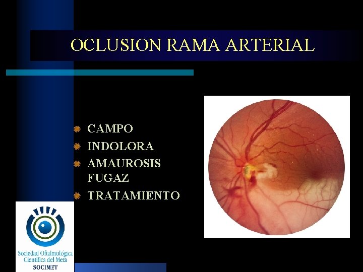 OCLUSION RAMA ARTERIAL CAMPO INDOLORA AMAUROSIS FUGAZ TRATAMIENTO 