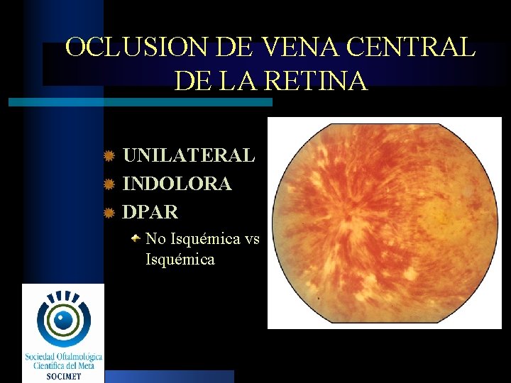 OCLUSION DE VENA CENTRAL DE LA RETINA UNILATERAL INDOLORA DPAR No Isquémica vs Isquémica