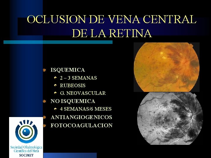 OCLUSION DE VENA CENTRAL DE LA RETINA ISQUEMICA 2 – 3 SEMANAS RUBEOSIS G.