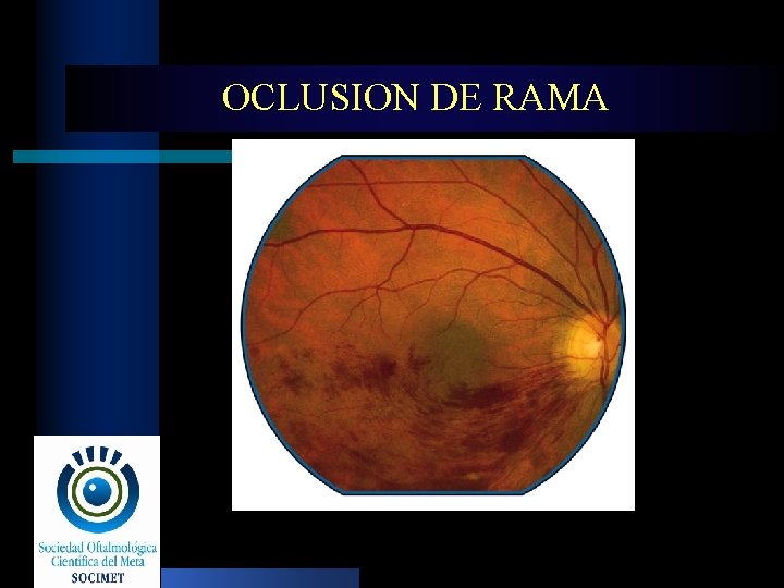 OCLUSION DE RAMA 