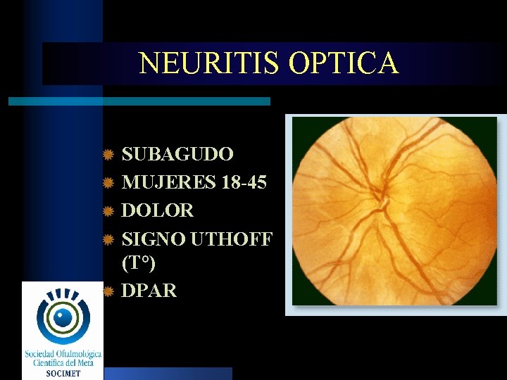 NEURITIS OPTICA SUBAGUDO MUJERES 18 -45 DOLOR SIGNO UTHOFF (T°) DPAR 