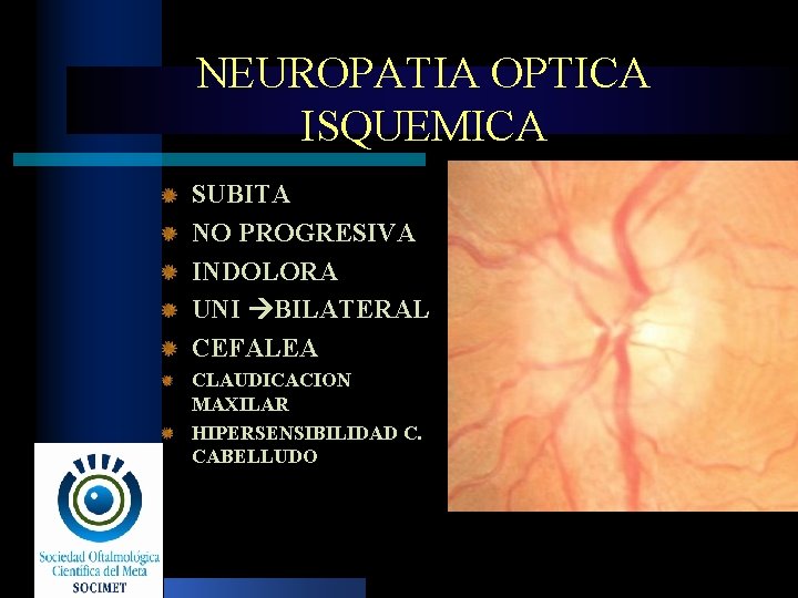 NEUROPATIA OPTICA ISQUEMICA SUBITA NO PROGRESIVA INDOLORA UNI BILATERAL CEFALEA CLAUDICACION MAXILAR HIPERSENSIBILIDAD C.