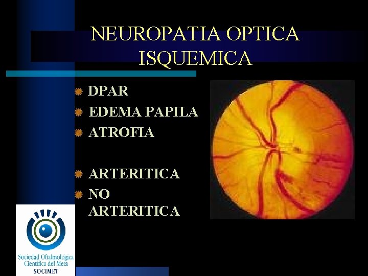 NEUROPATIA OPTICA ISQUEMICA DPAR EDEMA PAPILA ATROFIA ARTERITICA NO ARTERITICA 