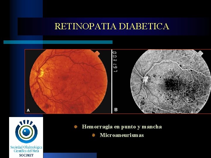 RETINOPATIA DIABETICA Hemorragia en punto y mancha Microaneurismas 