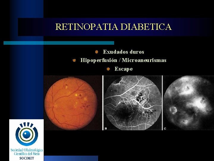 RETINOPATIA DIABETICA Exudados duros Hipoperfusión / Microaneurismas Escape 