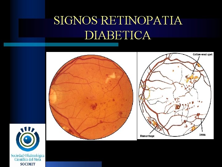 SIGNOS RETINOPATIA DIABETICA 