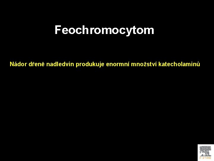 Feochromocytom Nádor dřeně nadledvin produkuje enormní množství katecholaminů 