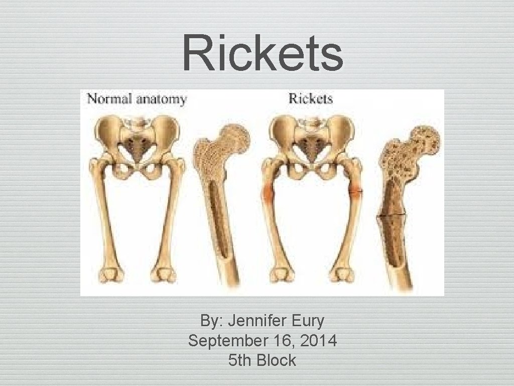 Rickets By: Jennifer Eury September 16, 2014 5 th Block 