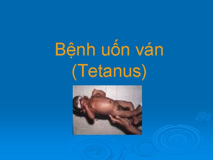 Bệnh uốn ván (Tetanus) 