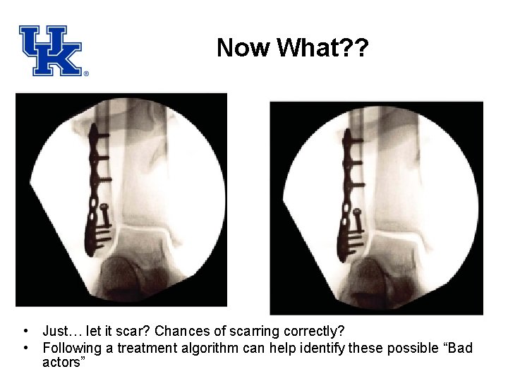 Now What? ? • Just… let it scar? Chances of scarring correctly? • Following