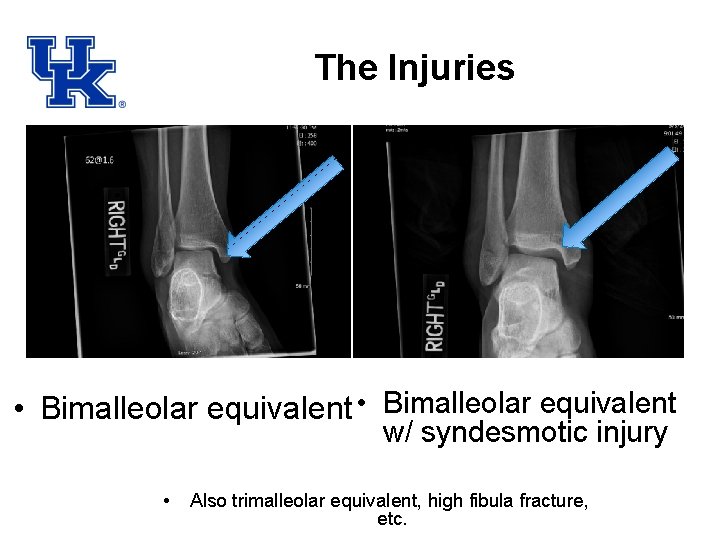 The Injuries • Bimalleolar equivalent w/ syndesmotic injury • Also trimalleolar equivalent, high fibula