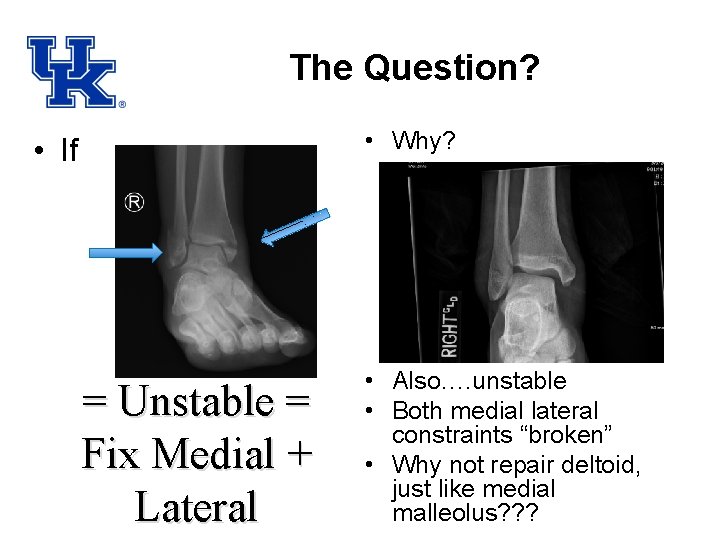 The Question? • Why? • If = Unstable = Fix Medial + Lateral •