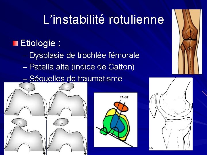 L’instabilité rotulienne Etiologie : – Dysplasie de trochlée fémorale – Patella alta (indice de L’instabilité rotulienne Etiologie : – Dysplasie de trochlée fémorale – Patella alta (indice de