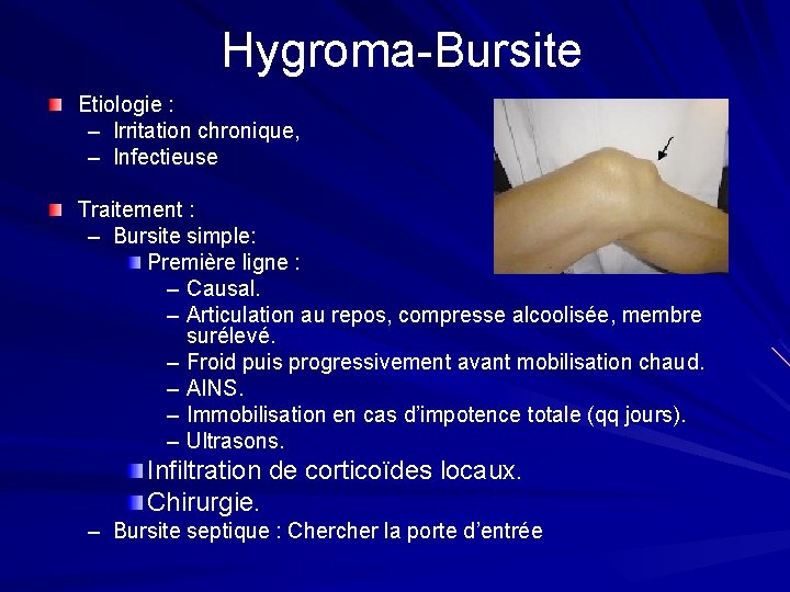 Hygroma-Bursite Etiologie : – Irritation chronique, – Infectieuse Traitement : – Bursite simple: Première Hygroma-Bursite Etiologie : – Irritation chronique, – Infectieuse Traitement : – Bursite simple: Première