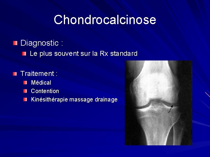 Chondrocalcinose Diagnostic : Le plus souvent sur la Rx standard Traitement : Médical Contention Chondrocalcinose Diagnostic : Le plus souvent sur la Rx standard Traitement : Médical Contention