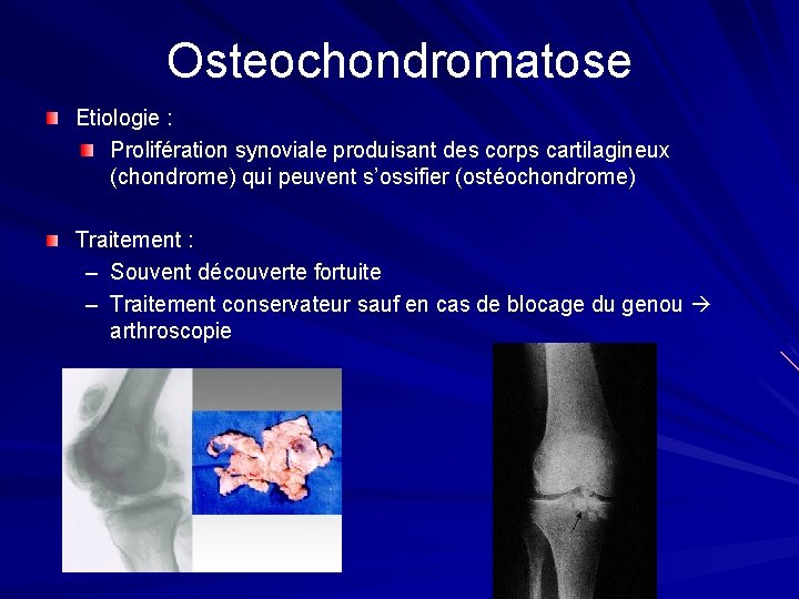 Osteochondromatose Etiologie : Prolifération synoviale produisant des corps cartilagineux (chondrome) qui peuvent s’ossifier (ostéochondrome) Osteochondromatose Etiologie : Prolifération synoviale produisant des corps cartilagineux (chondrome) qui peuvent s’ossifier (ostéochondrome)