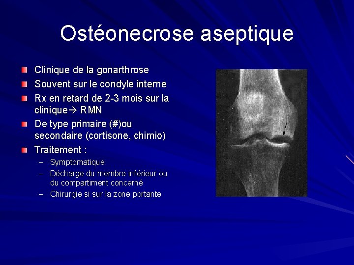 Ostéonecrose aseptique Clinique de la gonarthrose Souvent sur le condyle interne Rx en retard Ostéonecrose aseptique Clinique de la gonarthrose Souvent sur le condyle interne Rx en retard