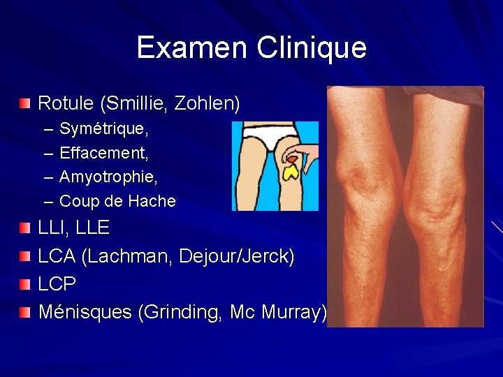 Examen Clinique Rotule (Smillie, Zohlen) – – Symétrique, Effacement, Amyotrophie, Coup de Hache LLI, Examen Clinique Rotule (Smillie, Zohlen) – – Symétrique, Effacement, Amyotrophie, Coup de Hache LLI,