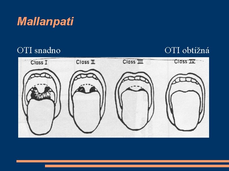 Mallanpati OTI snadno OTI obtížná 