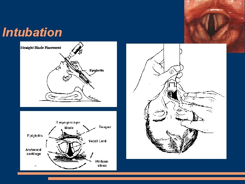 Intubation 