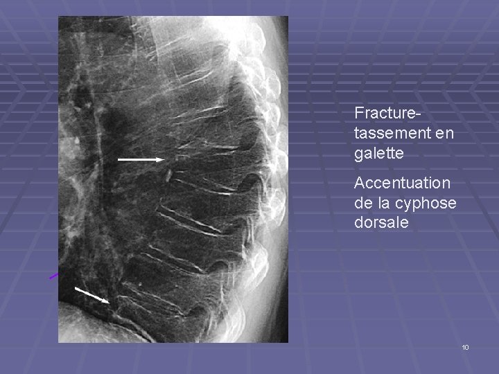 Fracturetassement en galette Accentuation de la cyphose dorsale 10 