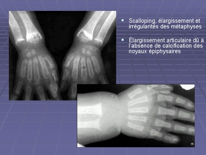 § Scalloping, élargissement et irrégularités des métaphyses § Élargissement articulaire dû à l’absence de