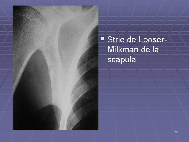 § Strie de Looser. Milkman de la scapula 18 