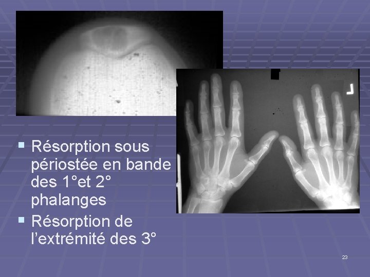 § Résorption sous périostée en bande des 1°et 2° phalanges § Résorption de l’extrémité