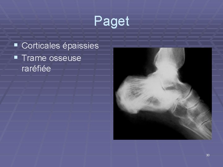 Paget § Corticales épaissies § Trame osseuse raréfiée 30 