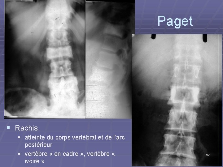 Paget § Rachis § atteinte du corps vertébral et de l’arc postérieur § vertèbre