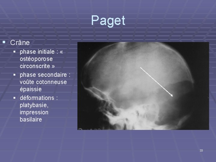 Paget § Crâne § phase initiale : « ostéoporose circonscrite » § phase secondaire