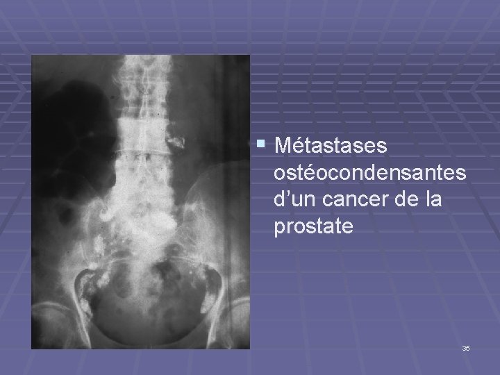 § Métastases ostéocondensantes d’un cancer de la prostate 35 