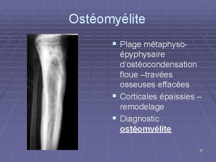 Ostéomyélite § Plage métaphysoépyphysaire d’ostéocondensation floue –travées osseuses effacées § Corticales épaissies – remodelage
