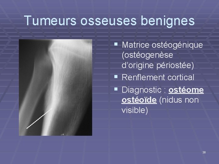 Tumeurs osseuses benignes § Matrice ostéogénique (ostéogenèse d’origine périostée) § Renflement cortical § Diagnostic