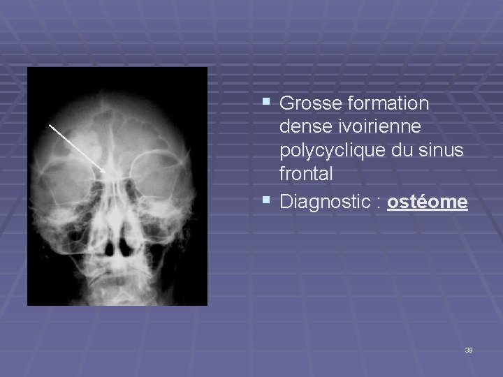§ Grosse formation dense ivoirienne polycyclique du sinus frontal § Diagnostic : ostéome 39