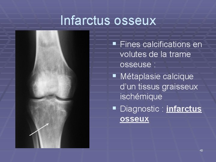Infarctus osseux § Fines calcifications en volutes de la trame osseuse : § Métaplasie