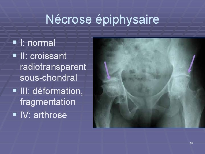 Nécrose épiphysaire § I: normal § II: croissant radiotransparent sous-chondral § III: déformation, fragmentation